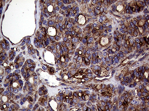 GNAS Antibody - Immunohistochemical staining of paraffin-embedded Carcinoma of Human thyroid tissue using anti-GNAS mouse monoclonal antibody. (Heat-induced epitope retrieval by 1mM EDTA in 10mM Tris buffer. (pH8.5) at 120°C for 3 min. (1:500)