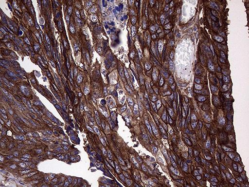 GNAS Antibody - Immunohistochemical staining of paraffin-embedded Adenocarcinoma of Human colon tissue using anti-GNAS mouse monoclonal antibody. (Heat-induced epitope retrieval by 1mM EDTA in 10mM Tris buffer. (pH8.5) at 120°C for 3 min. (1:150)(1:500)