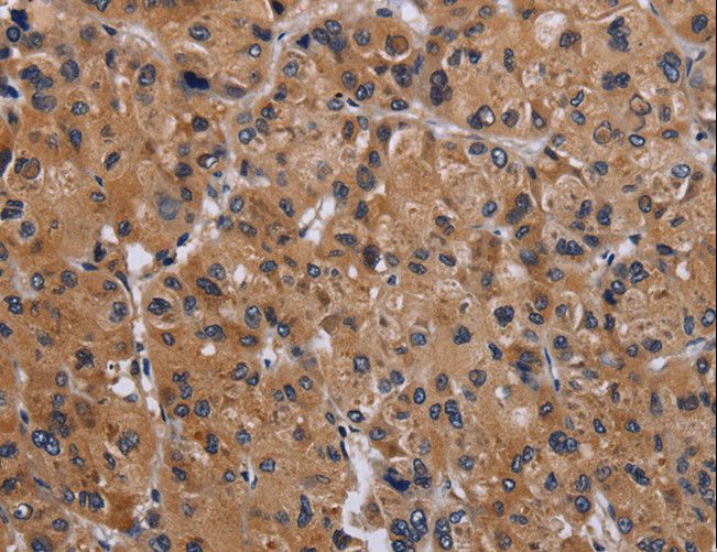 GNAS Antibody - Immunohistochemistry of paraffin-embedded Human liver cancer using GNAS Polyclonal Antibody at dilution of 1:30.