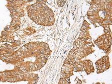 GNAT1 Antibody - Immunohistochemistry of paraffin-embedded Human colorectal cancer tissue  using GNAT1 Polyclonal Antibody at dilution of 1:25(×200)
