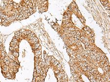 GNAT1 Antibody - Immunohistochemistry of paraffin-embedded Human colorectal cancer tissue  using GNAT1 Polyclonal Antibody at dilution of 1:25(×200)