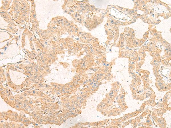 GNAT3 / Gustducin Antibody - Immunohistochemistry of paraffin-embedded Human thyroid cancer tissue  using GNAT3 Polyclonal Antibody at dilution of 1:40(×200)