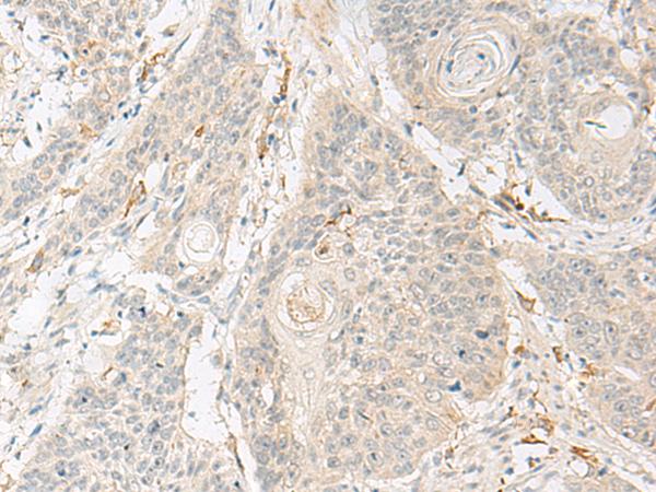 GNAT3 / Gustducin Antibody - Immunohistochemistry of paraffin-embedded Human esophagus cancer tissue  using GNAT3 Polyclonal Antibody at dilution of 1:40(×200)