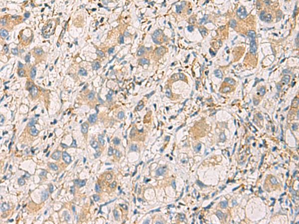 GNAZ Antibody - Immunohistochemistry of paraffin-embedded Human liver cancer tissue  using GNAZ Polyclonal Antibody at dilution of 1:70(×200)