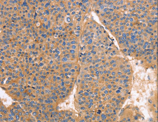 GNB1 Antibody - Immunohistochemistry of paraffin-embedded Human liver cancer using GNB1 Polyclonal Antibody at dilution of 1:25.
