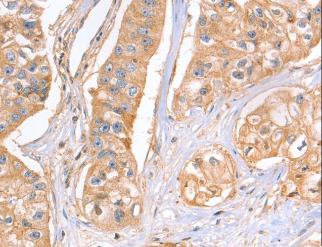 GNB1 Antibody - Immunohistochemistry of paraffin-embedded Human breast cancer using GNB1 Polyclonal Antibody at dilution of 1:25.
