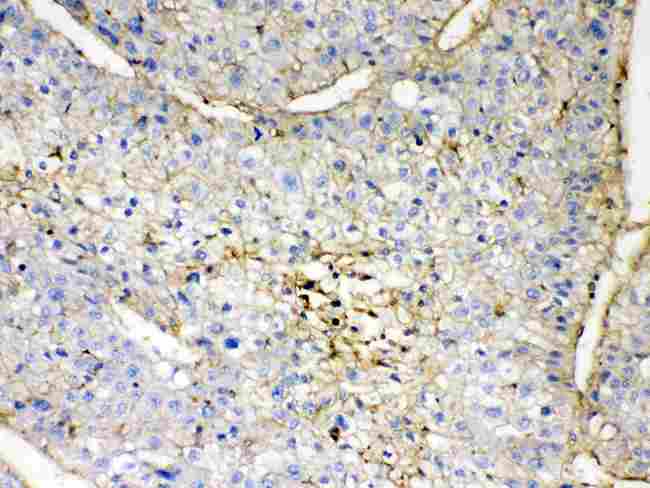 GNB1 Antibody - IHC analysis of GNB1 using anti-GNB1 antibody. GNB1 was detected in paraffin-embedded section of human liver cancer tissue. Heat mediated antigen retrieval was performed in citrate buffer (pH6, epitope retrieval solution) for 20 mins. The tissue section was blocked with 10% goat serum. The tissue section was then incubated with 1µg/ml rabbit anti-GNB1 Antibody overnight at 4°C. Biotinylated goat anti-rabbit IgG was used as secondary antibody and incubated for 30 minutes at 37°C. The tissue section was developed using Strepavidin-Biotin-Complex (SABC) with DAB as the chromogen.