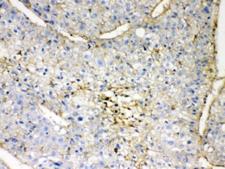 GNB1 Antibody - IHC testing of FFPE human liver cancer tissue with GNB1 antibody at 1ug/ml. HIER: steam section in pH6 citrate buffer for 20 min.
