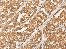 GNB1L / FKSG1 Antibody - Immunohistochemistry of paraffin-embedded Human liver cancer tissue  using GNB1L Polyclonal Antibody at dilution of 1:35(×200)