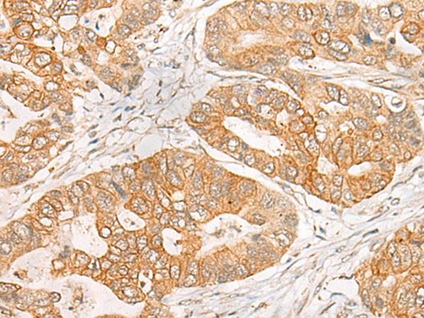 GNB1L / FKSG1 Antibody - Immunohistochemistry of paraffin-embedded Human gastric cancer tissue  using GNB1L Polyclonal Antibody at dilution of 1:35(×200)