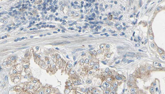 GNB2 Antibody - 1:100 staining human prostate tissue by IHC-P. The sample was formaldehyde fixed and a heat mediated antigen retrieval step in citrate buffer was performed. The sample was then blocked and incubated with the antibody for 1.5 hours at 22°C. An HRP conjugated goat anti-rabbit antibody was used as the secondary.