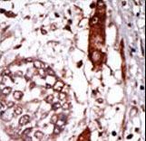 GNB2L1 / RACK1 Antibody - Formalin-fixed and paraffin-embedded human cancer tissue reacted with the primary antibody, which was peroxidase-conjugated to the secondary antibody, followed by AEC staining. This data demonstrates the use of this antibody for immunohistochemistry; clinical relevance has not been evaluated. BC = breast carcinoma; HC = hepatocarcinoma.