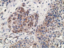 GNB2L1 / RACK1 Antibody - IHC of paraffin-embedded Carcinoma of Human bladder tissue using anti-GNB2L1 mouse monoclonal antibody. (Heat-induced epitope retrieval by 10mM citric buffer, pH6.0, 100C for 10min).