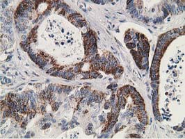 GNB2L1 / RACK1 Antibody - IHC of paraffin-embedded Adenocarcinoma of Human colon tissue using anti-GNB2L1 mouse monoclonal antibody. (Heat-induced epitope retrieval by 10mM citric buffer, pH6.0, 100C for 10min).