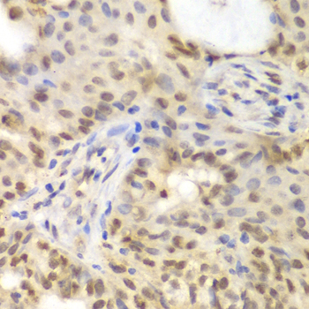 GNB2L1 / RACK1 Antibody - Immunohistochemistry of paraffin-embedded human oophoroma tissue.