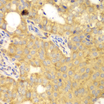 GNB2L1 / RACK1 Antibody - Immunohistochemistry of paraffin-embedded human oophoroma using GNB2L1 antibody at dilution of 1:100 (40x lens).