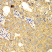 GNB2L1 / RACK1 Antibody - Immunohistochemistry of paraffin-embedded human oophoroma using GNB2L1 antibody at dilution of 1:100 (40x lens).