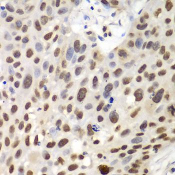 GNB2L1 / RACK1 Antibody - Immunohistochemistry of paraffin-embedded human lung cancer using GNB2L1 antibody at dilution of 1:100 (40x lens).