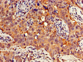 GNB4 Antibody - Immunohistochemistry of paraffin-embedded human pancreatic cancer using GNB4 Antibody at dilution of 1:100
