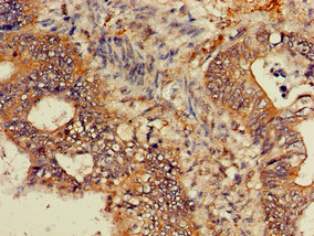 GNB4 Antibody - Immunohistochemistry of paraffin-embedded human colon cancer using GNB4 Antibody at dilution of 1:100