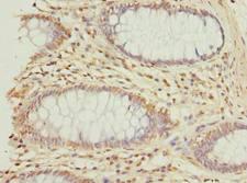 GNG10 Antibody - Immunohistochemistry of paraffin-embedded human colon cancer using antibody at dilution of 1:100.