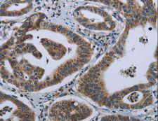 GNG2 Antibody - Immunohistochemistry of paraffin-embedded Human gastric cancer using GNG2 Polyclonal Antibody at dilution of 1:50.
