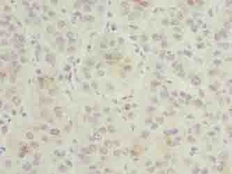 GNG5 Antibody - Immunohistochemistry of paraffin-embedded human liver cancer using antibody at dilution of 1:100.