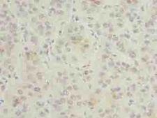 GNG5 Antibody - Immunohistochemistry of paraffin-embedded human liver cancer using antibody at dilution of 1:100.