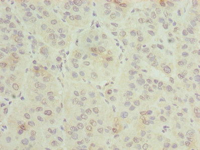 GNG5 Antibody - Immunohistochemistry of paraffin-embedded human liver cancer using GNG5 Antibody at dilution of 1:100