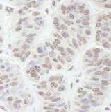 GNL3 / NS / Nucleostemin Antibody - Detection of Human GNL3 by Immunohistochemistry. Sample: FFPE section of human skin carcinoma. Antibody: Affinity purified rabbit anti-GNL3 used at a dilution of 1:200 (1 Detection: DAB.
