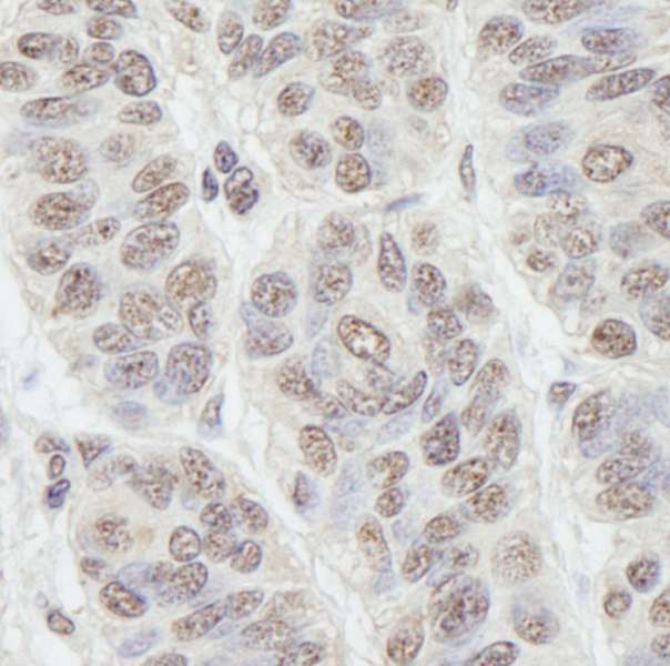 GNL3 / NS / Nucleostemin Antibody - Detection of Human GNL3 by Immunohistochemistry. Sample: FFPE section of human skin carcinoma. Antibody: Affinity purified rabbit anti-GNL3 used at a dilution of 1:1000 (0.2 Detection: DAB.