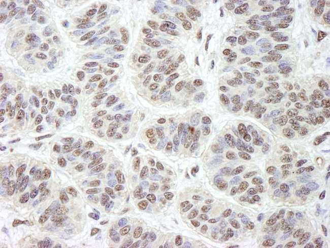 GNL3 / NS / Nucleostemin Antibody - Detection of Human GNL3 by Immunohistochemistry. Sample: FFPE section of human skin basal cell carcinoma. Antibody: Affinity purified rabbit anti-GNL3 used at a dilution of 1:500. Detection: DAB staining using anti-Rabbit IHC antibody at a dilution of 1:100.