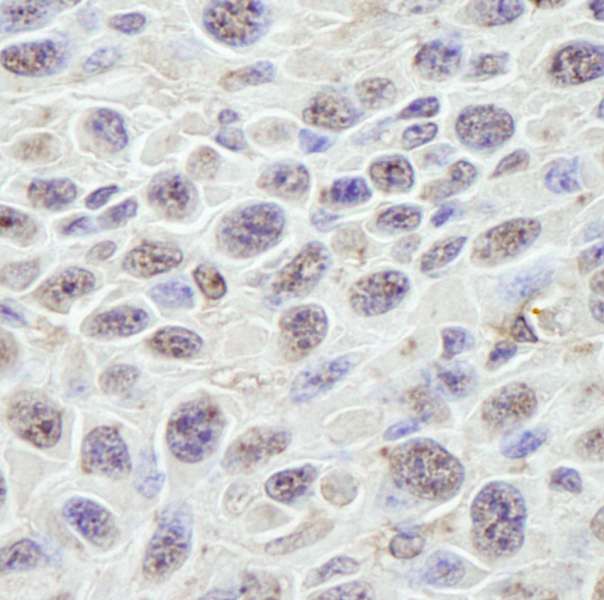 GNL3 / NS / Nucleostemin Antibody - Detection of Mouse GNL3 by Immunohistochemistry. Sample: FFPE section of mouse squamous cell carcinoma. Antibody: Affinity purified rabbit anti-GNL3 used at a dilution of 1:100. Detection: DAB staining using anti-Rabbit IHC antibody at a dilution of 1:100.
