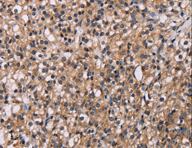 GNL3 / NS / Nucleostemin Antibody - Immunohistochemistry of paraffin-embedded Human prostate cancer using GNL3 Polyclonal Antibody at dilution of 1:60.