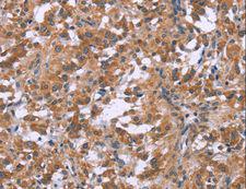 GNPAT / DHAP-AT Antibody - Immunohistochemistry of paraffin-embedded Human cervical cancer using GNPAT Polyclonal Antibody at dilution of 1:40.