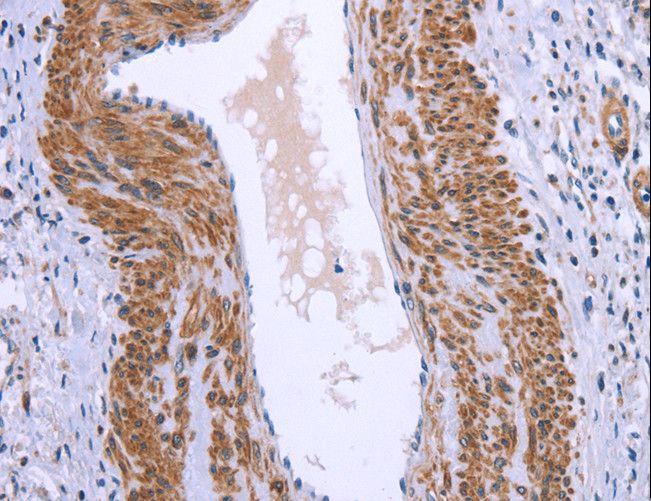 GNPAT / DHAP-AT Antibody - Immunohistochemistry of paraffin-embedded Human cervical cancer using GNPAT Polyclonal Antibody at dilution of 1:40.