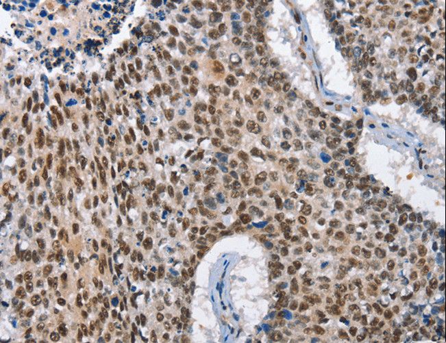 GNRH Antibody - Immunohistochemistry of paraffin-embedded Human lung cancer using GNRH1 Polyclonal Antibody at dilution of 1:65.