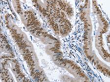 GNRH Antibody - Immunohistochemistry of paraffin-embedded Human colon cancer tissue  using GNRH1 Polyclonal Antibody at dilution of 1:70(×200)