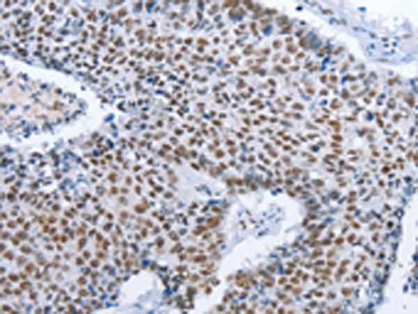 GNRH Antibody - Immunohistochemistry of paraffin-embedded Human lung cancer tissue  using GNRH1 Polyclonal Antibody at dilution of 1:70(×200)