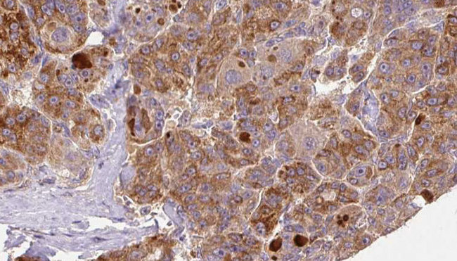 GnRH-II-R / GNRHR2 Antibody - 1:100 staining human liver carcinoma tissues by IHC-P. The sample was formaldehyde fixed and a heat mediated antigen retrieval step in citrate buffer was performed. The sample was then blocked and incubated with the antibody for 1.5 hours at 22°C. An HRP conjugated goat anti-rabbit antibody was used as the secondary.