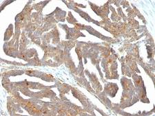 GnRH receptor / GNRHR Antibody - Formalin-fixed, paraffin-embedded human ovarian carcinoma stained with GnRH Receptor antibody (F1G4).  This image was taken for the unmodified form of this product. Other forms have not been tested.