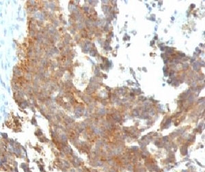 GnRH receptor / GNRHR Antibody - Formalin-fixed, paraffin-embedded human ovarian carcinoma stained with GnRH Receptor antibody (GNRHR/768).  This image was taken for the unmodified form of this product. Other forms have not been tested.