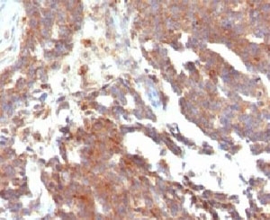 GnRH receptor / GNRHR Antibody - IHC testing of FFPE human ovarian carcinoma and GnRHR antibody (clone LCHR37).  This image was taken for the unmodified form of this product. Other forms have not been tested.