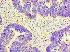 GNRH2 Antibody - Immunohistochemistry of paraffin-embedded human ovarian cancer using antibody at 1:100 dilution.  This image was taken for the unconjugated form of this product. Other forms have not been tested.