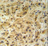 GNS Antibody - GNS Antibody (Center N189) IHC of formalin-fixed and paraffin-embedded human hepatocarcinoma followed by peroxidase-conjugated secondary antibody and DAB staining.