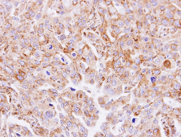 GNT-III / MGAT3 Antibody - IHC of paraffin-embedded SW480 xenograft using MGAT3 antibody at 1:500 dilution.