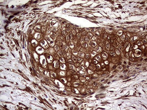 GOB5 / CLCA1 Antibody - Immunohistochemical staining of paraffin-embedded Carcinoma of Human bladder tissue using anti-CLCA1 mouse monoclonal antibody. (Heat-induced epitope retrieval by 1mM EDTA in 10mM Tris buffer. (pH8.5) at 120°C for 3 min. (1:500)