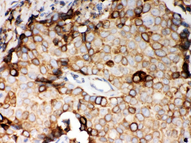 GOK / STIM1 Antibody - STIM1 antibody IHC-paraffin: Human Mammary Cancer Tissue.