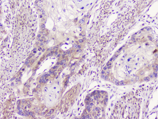 GOLGA2 / GM130 Antibody - IHC analysis of GM130 using anti-GM130 antibody. GM130 was detected in paraffin-embedded section of human oesophagus squama cancer tissue. Heat mediated antigen retrieval was performed in citrate buffer (pH6, epitope retrieval solution) for 20 mins. The tissue section was blocked with 10% goat serum. The tissue section was then incubated with 1µg/ml rabbit anti-GM130 Antibody overnight at 4°C. Biotinylated goat anti-rabbit IgG was used as secondary antibody and incubated for 30 minutes at 37°C. The tissue section was developed using Strepavidin-Biotin-Complex (SABC) with DAB as the chromogen.
