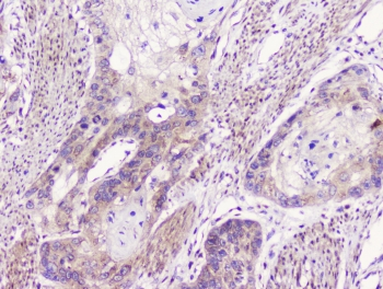 GOLGA2 / GM130 Antibody - IHC staining of FFPE human esophagus squama cancer with GM130 antibody at 0.5ug/ml. HIER: boil tissue sections in pH6, 10mM citrate buffer, for 10-20 min followed by cooling at RT for 20 min.